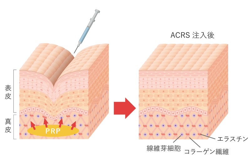 ACRSはニキビ跡（クレーター）の改善に効果的