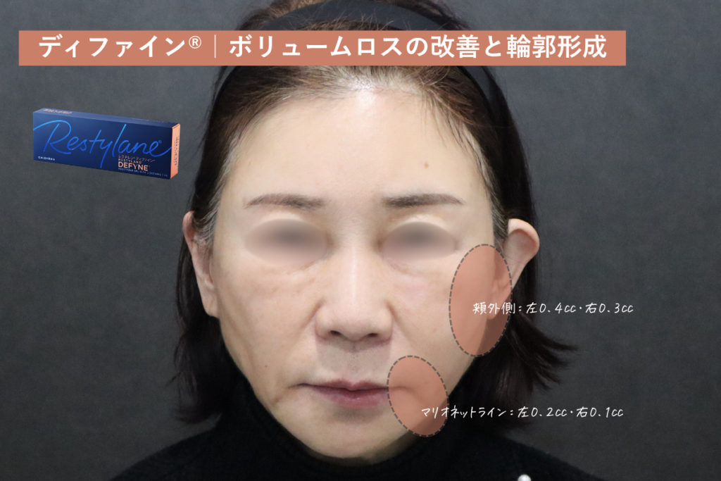 ディファイン®|ボリュームロスの改善と輪郭形成