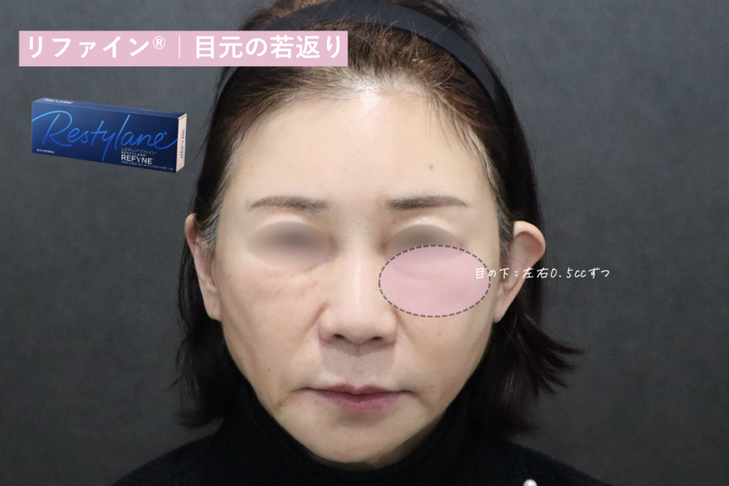 リファイン®|目元の若返り