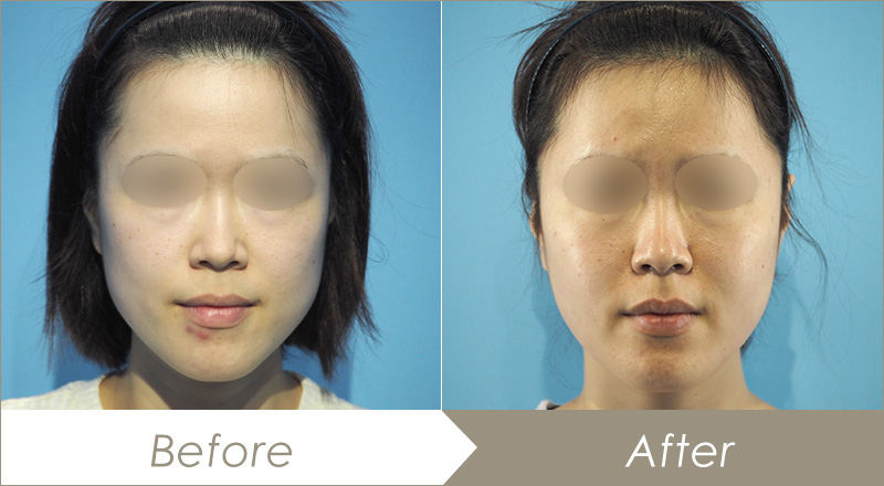 頬脂肪除去(バッカルファット除去)の施術例