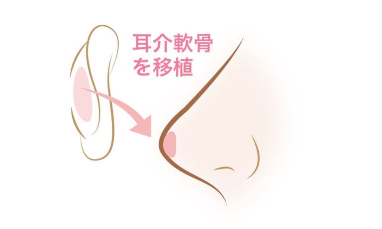 耳介軟骨の移植図