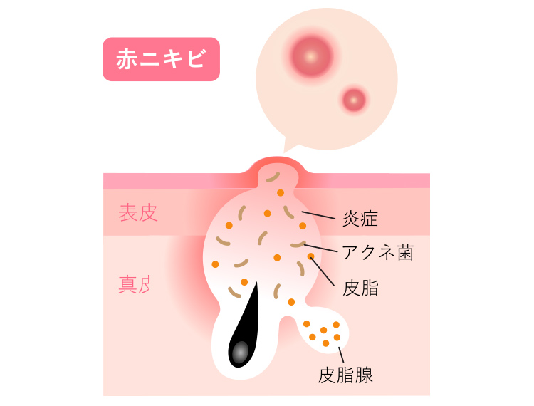赤ニキビとは詰まった毛穴の内部で、アクネ菌が増殖し、炎症を起こし、痛みを伴う状態