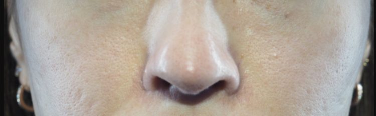 オステオポール除去前の鼻の画像