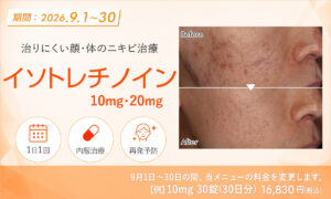 イソトレチノイン（ニキビ治療薬）