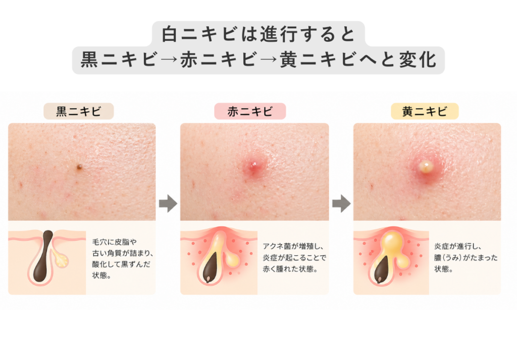白ニキビは進行すると黒ニキビ→赤ニキビ→黄ニキビになる