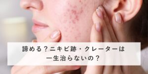 諦める？ニキビ跡・クレーターは一生治らないの？