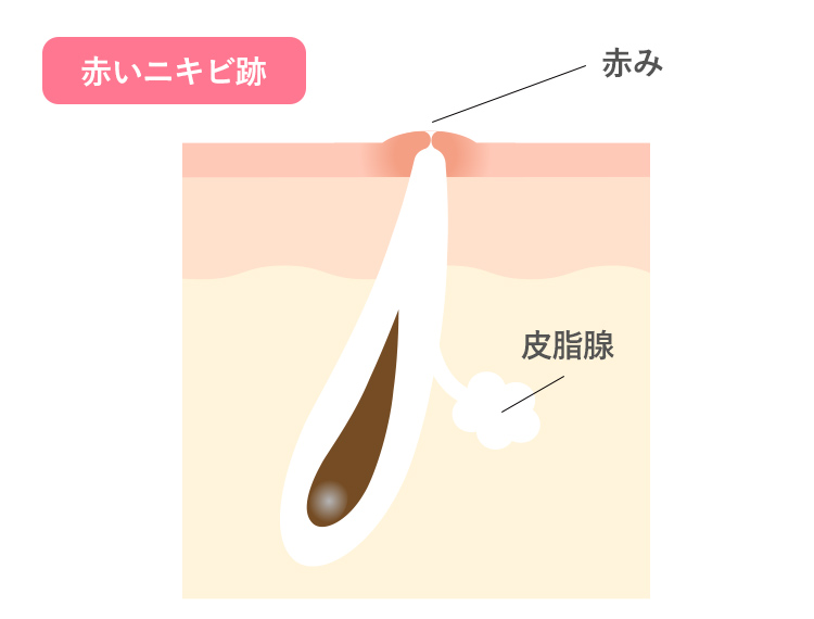赤いニキビ跡
