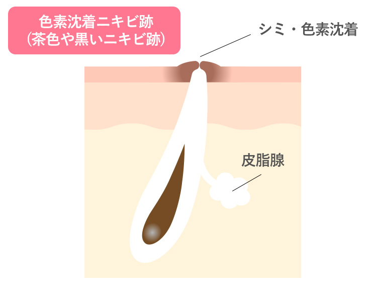 色素沈着ニキビ跡