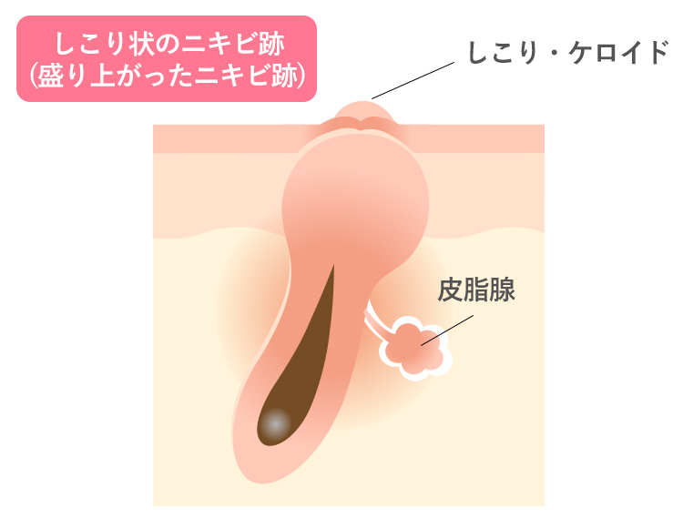 しこり状のニキビ跡