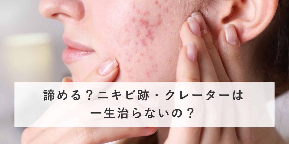 諦める？ニキビ跡・クレーターは一生治らないの？