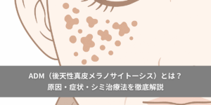 ADM（後天性真皮メラノサイトーシス）とは？原因・症状・シミ治療法を徹底解説