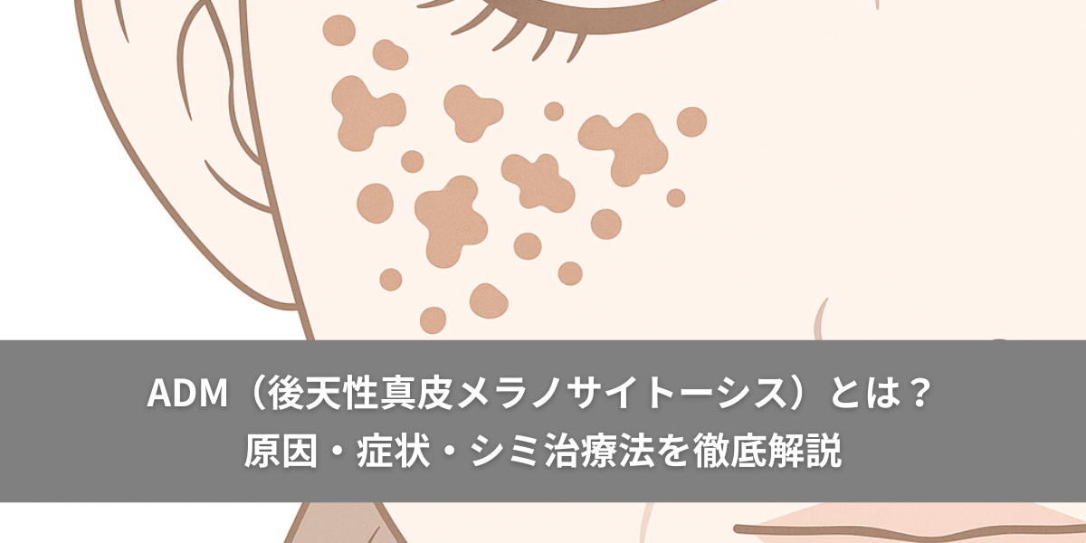 ADM（後天性真皮メラノサイトーシス）とは？