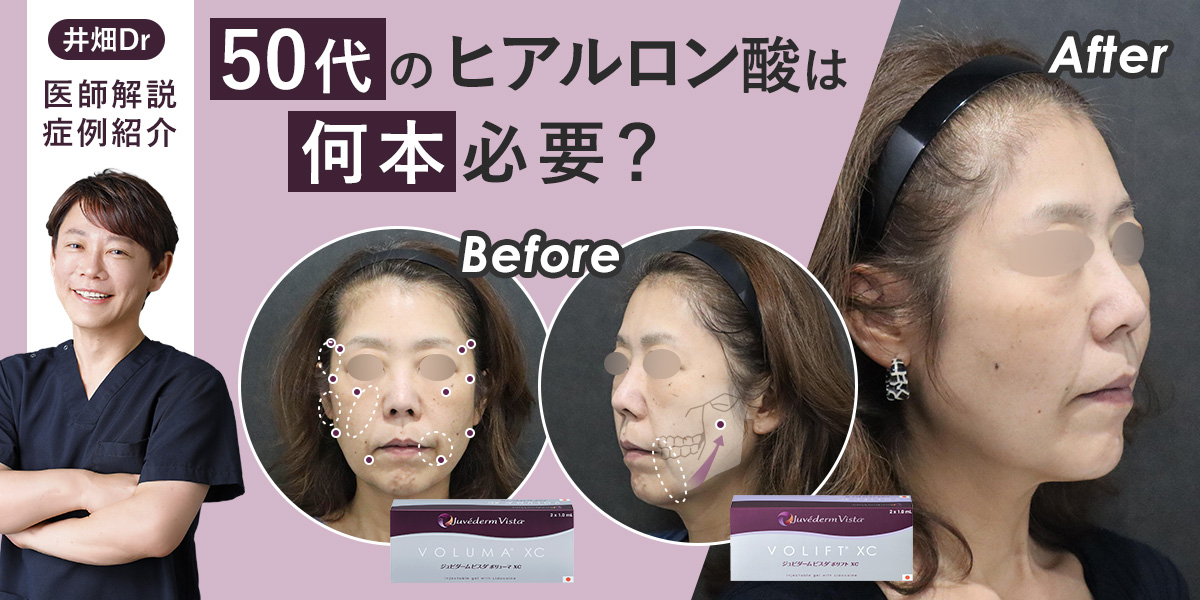 【症例解説】50代のヒアルロン酸は何本必要？