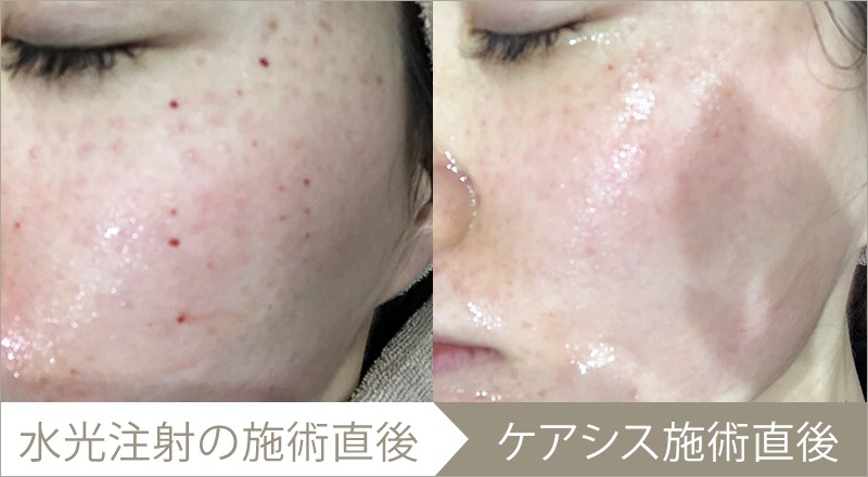 ケアシスの施術例(1回) – 症例写真