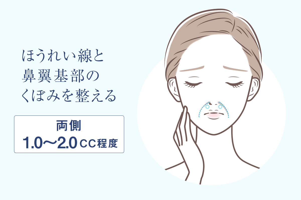 ほうれい線のヒアルロン酸注入量の目安・ほうれい線と鼻翼基部のくぼみを整える（両側1.0～2.0cc）