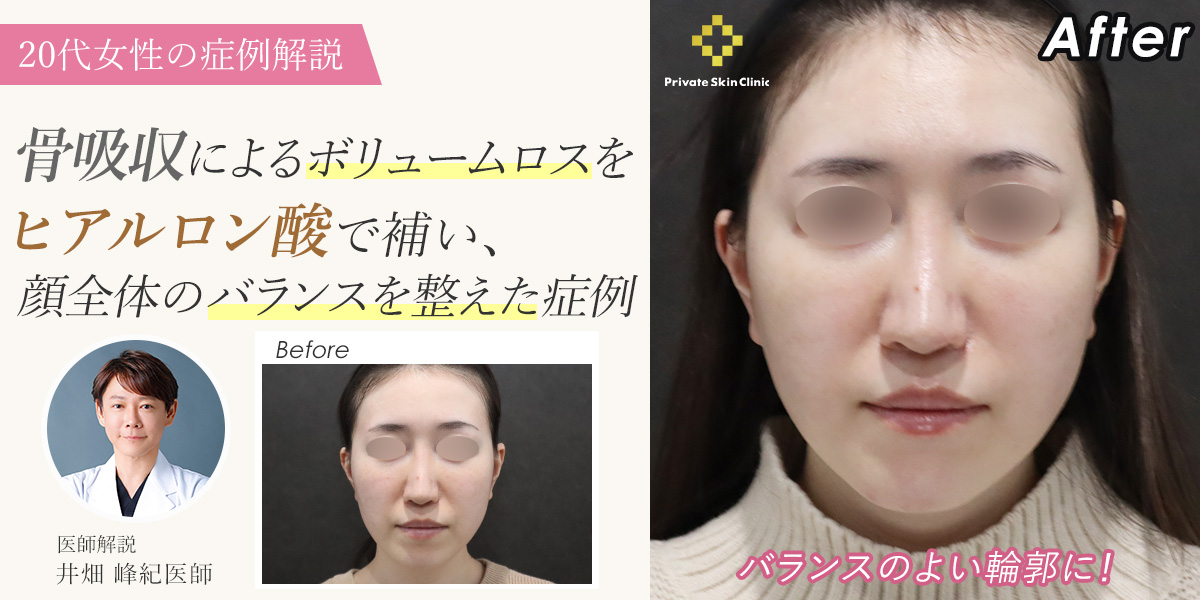 【症例解説】骨吸収によるボリュームロスをヒアルロン酸で補い、顔全体のバランスを整えた症例