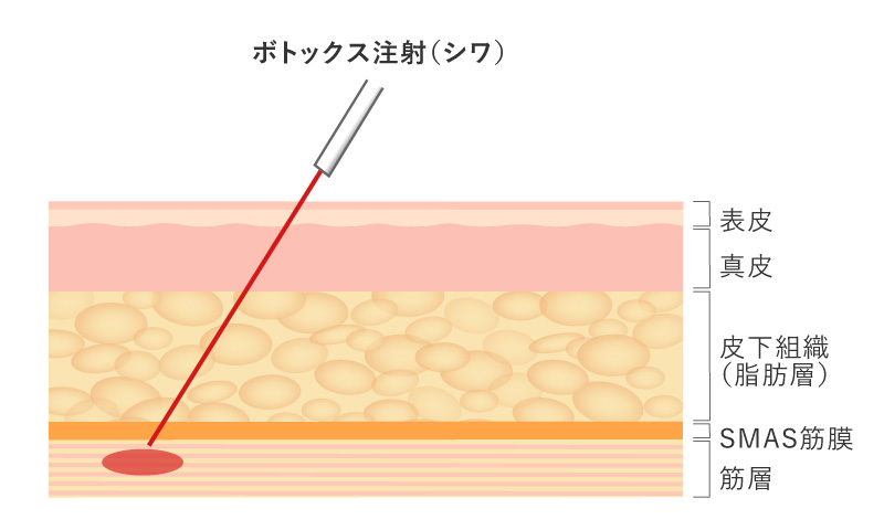 ボトックス注射（シワ）の注入レイヤー（層）