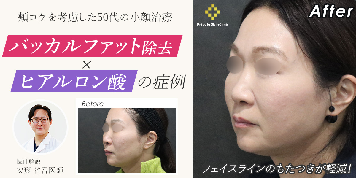 バッカルファット除去×ヒアルロン酸の症例｜頬コケを考慮した50代の小顔治療