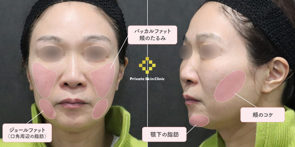 バッカルファットを取ると頬がコケるか不安の50代女性