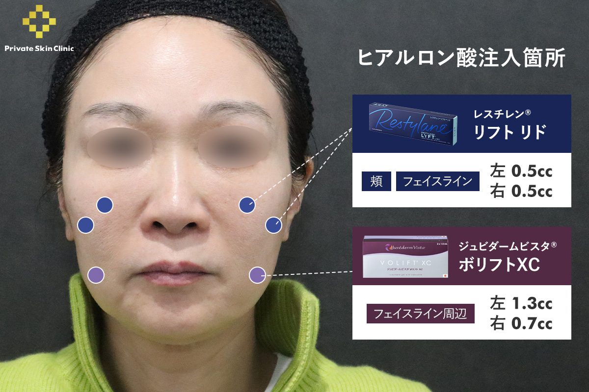 ヒアルロン酸の注入箇所