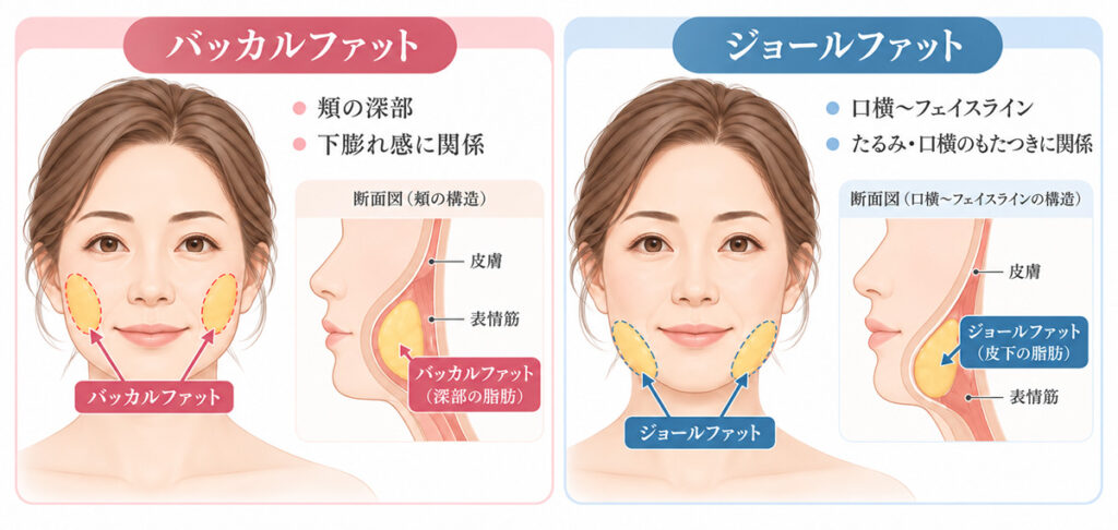 バッカルファットとジョールファットの違い