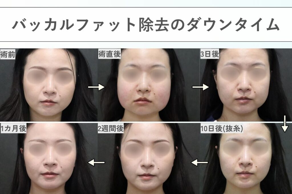 バッカルファット除去のダウンタイム