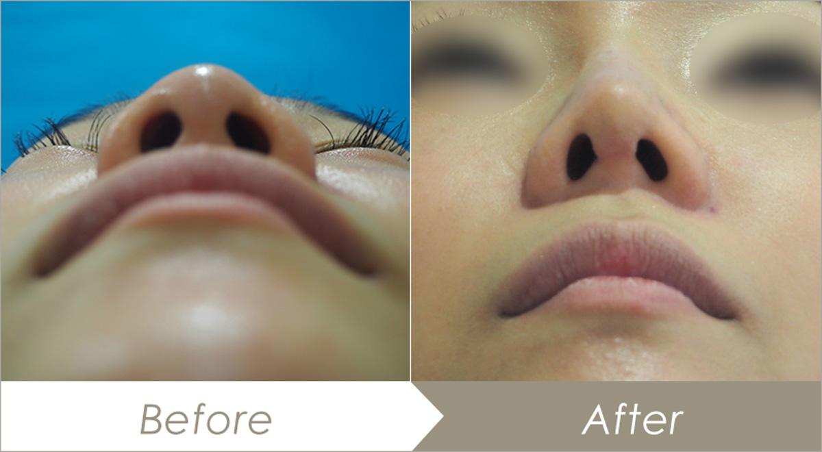 耳介軟骨移植（鼻）と鼻尖形成術（オープン法）の施術例-症例写真