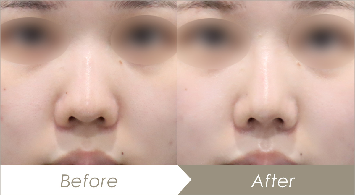 耳介軟骨移植（鼻）の施術例（併せて行った施術：鼻尖形成術鼻・プロテーゼ(隆鼻術)）-症例写真