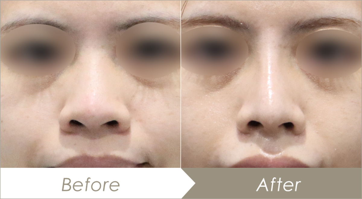 耳介軟骨移植（鼻）の施術例（併せて行った施術：鼻プロテーゼ(隆鼻術)・鼻尖形成術）-症例写真