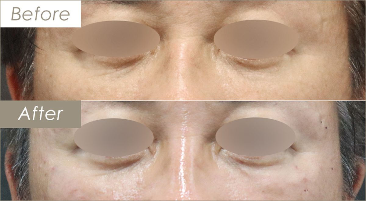 ベビーコラーゲン（1cc） – 症例写真