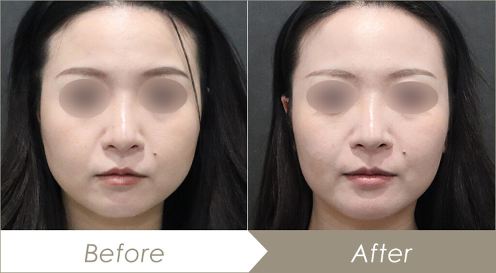 バッカルファット除去術（頬脂肪除去術）施術例（2カ月後）