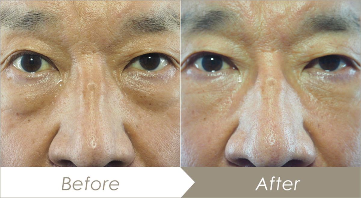 下瞼脂肪取り（経結膜的下眼瞼脱脂術）の施術例(下まぶた内側3か所)-症例写真