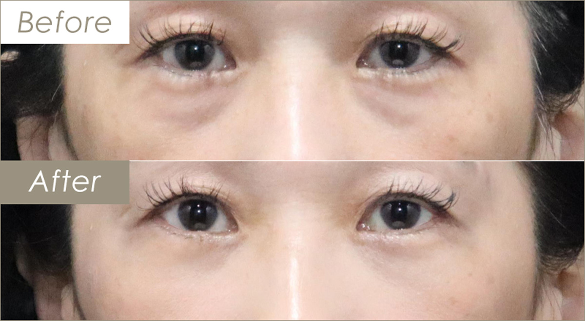 下瞼脂肪取り（経結膜的下眼瞼脱脂術）の施術例(下まぶた内側2か所ずつ)-症例写真