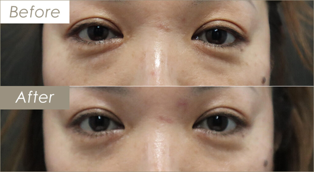 下瞼脂肪取りの施術例