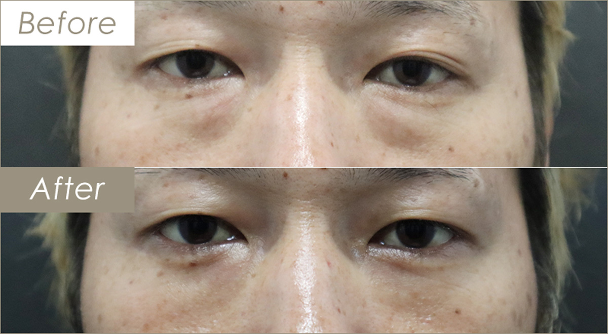 下瞼脂肪取り(両方)の施術例(下まぶたの内側切開)