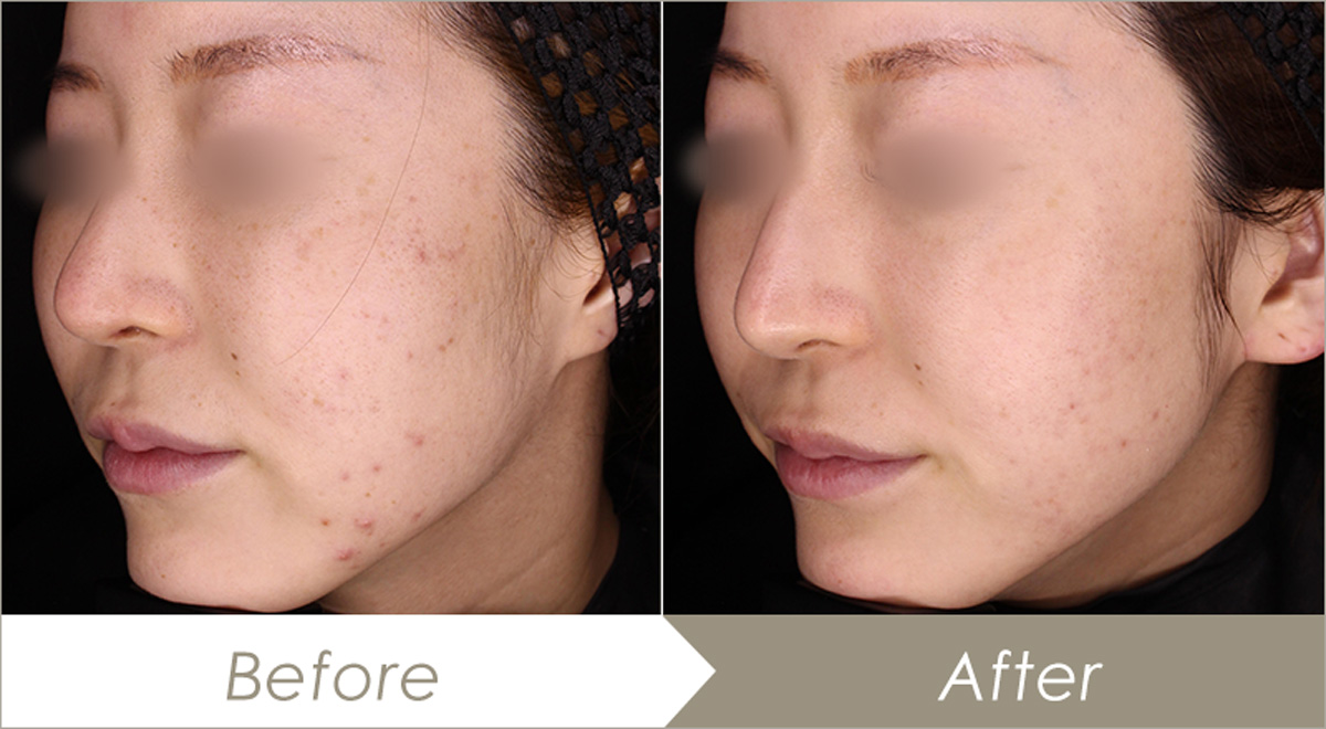 ダーマペン4の施術例-症例写真