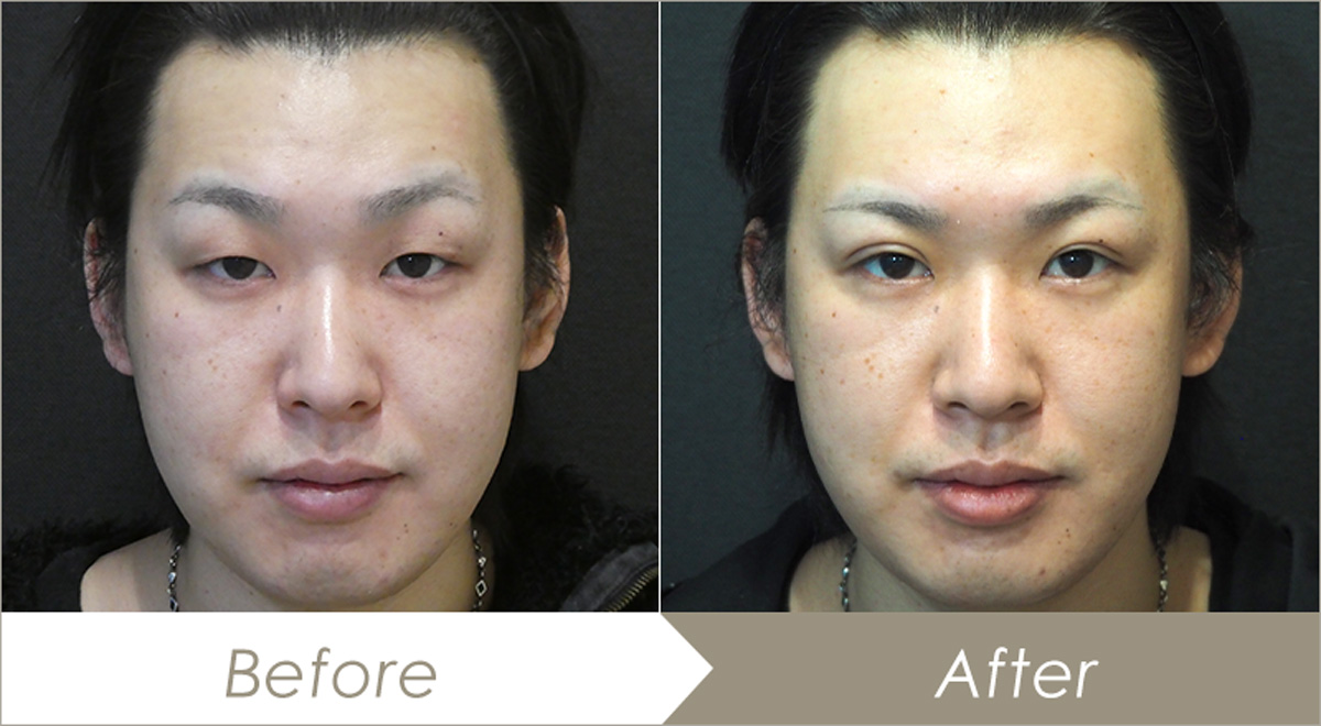 二重全切開法症例(施術前と施術後)