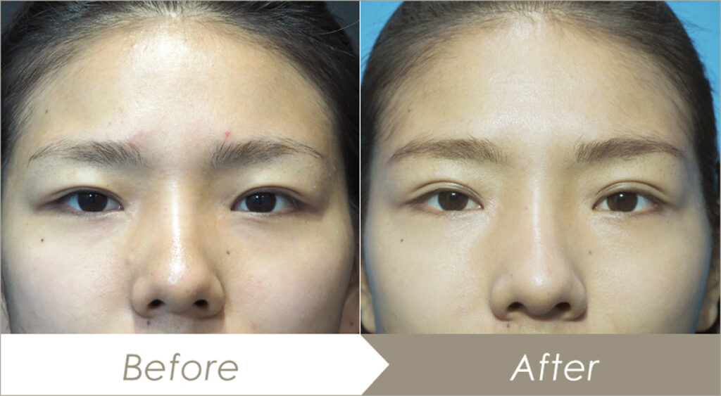 正面を向いた女性のビフォーアフター比較写真で、まぶたや目元の印象に変化が見られる画像