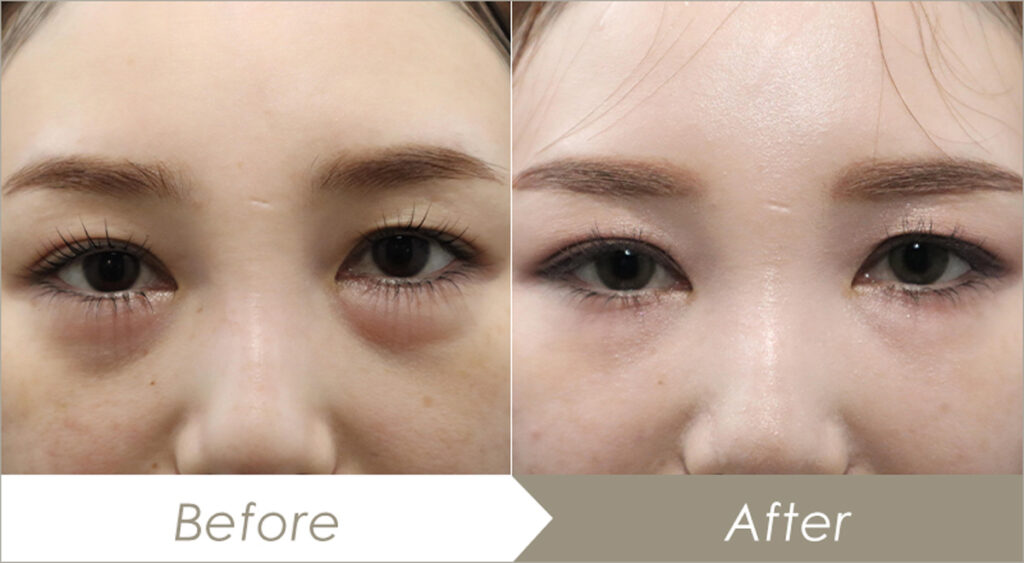 脂肪注入の施術例（併せて行った施術：下眼瞼脱脂術）