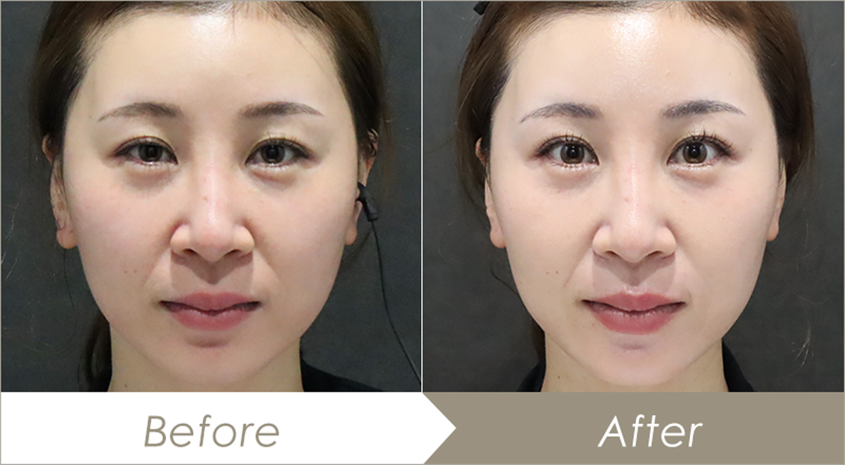 医療ハイフ（ウルトラフォーマーMPT）の症例