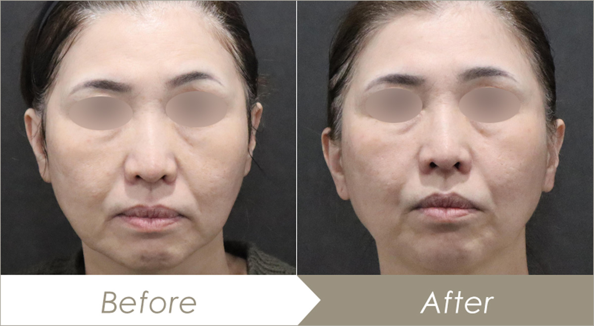 医療ハイフ+ヒアルロン酸リフトの施術例-症例写真