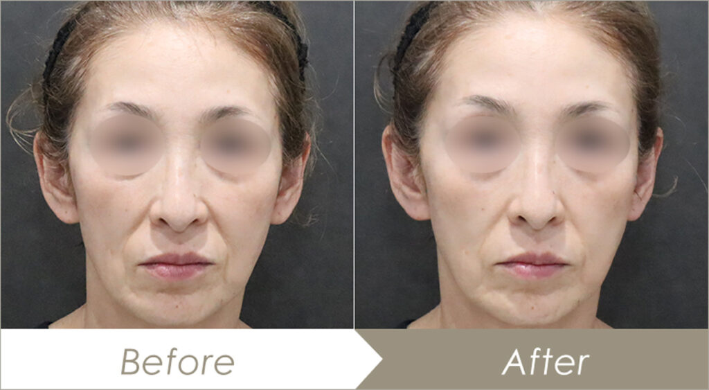 ロイヤル(HIFU+デンシティ)450ショットの施術例