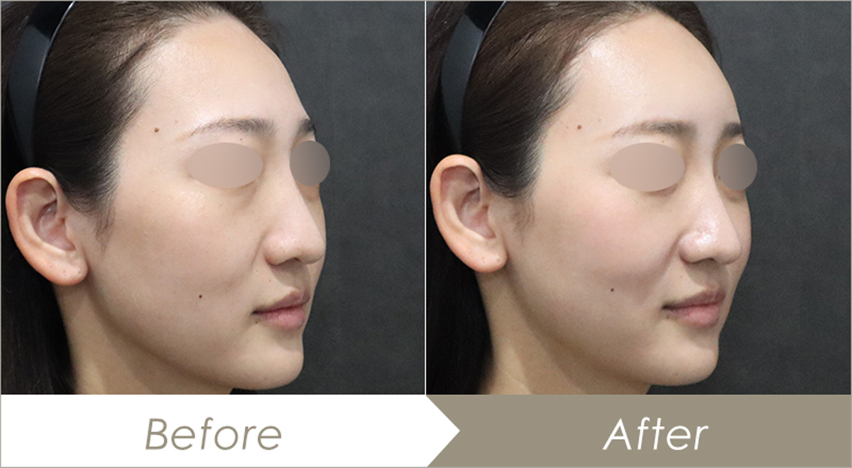 額(おでこ)ヒアルロン酸注入(レスチレン®リフトリド 3本)の施術例