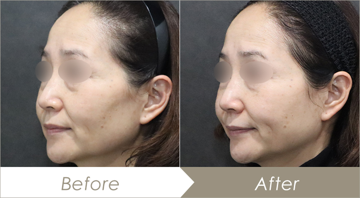 頬のヒアルロン酸注射の施術例（リフトリド2本・ボリューマXC1本・ボリフトXC3本） – 症例写真