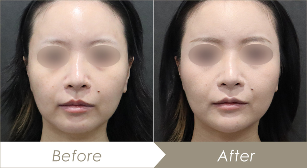 顎のヒアルロン酸注射（ボラックスXC1本）-症例写真