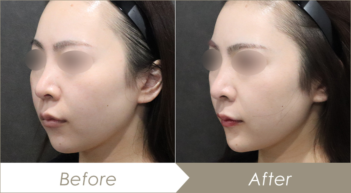 顎のヒアルロン酸注射（クレヴィエルコントア1本）-症例写真