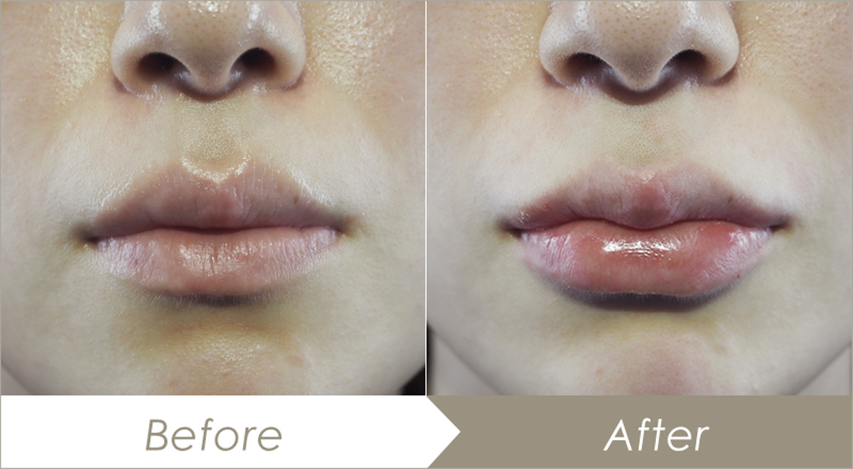 ヒアルロン酸注射（唇）の施術例-症例写真