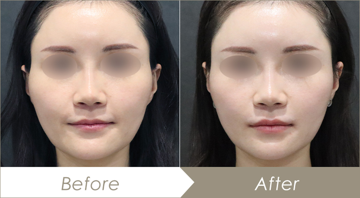 こめかみのヒアルロン酸注射（リフトリド1本・ボリフトXC1本）の施術例-症例写真