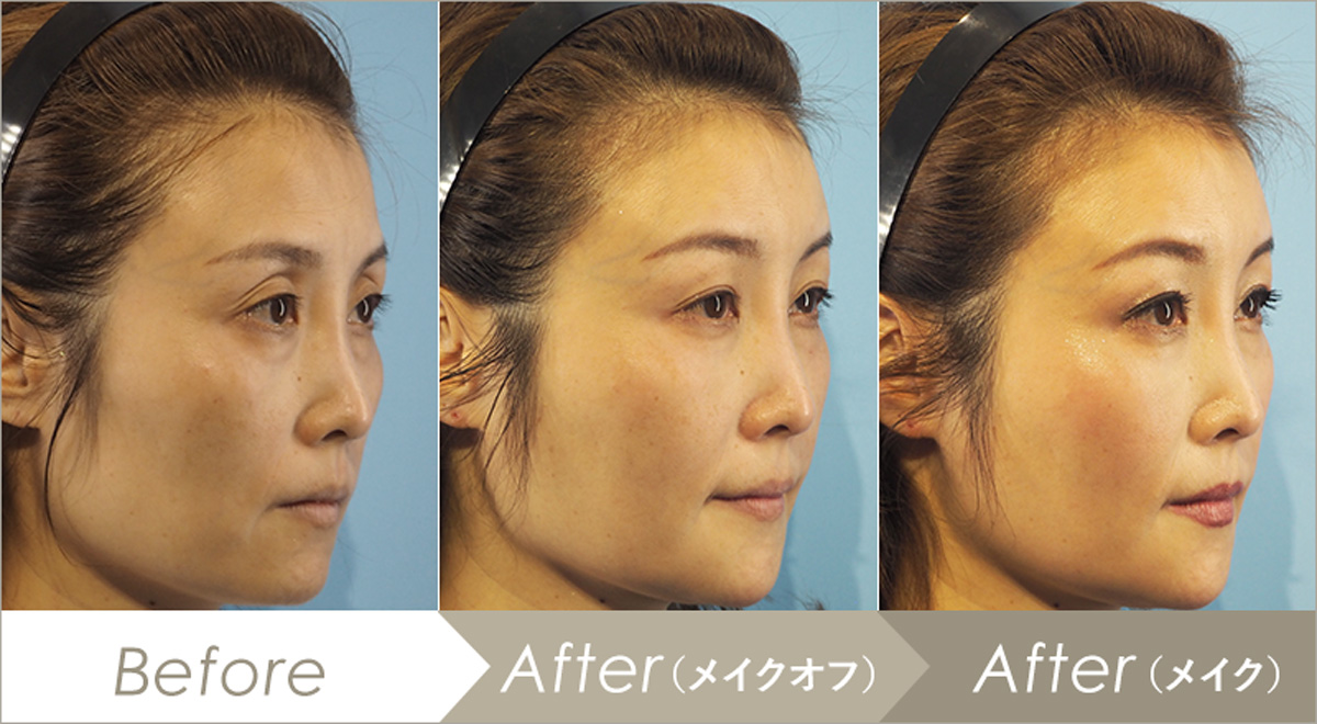 額(おでこ)ヒアルロン酸注入の施術例-症例写真