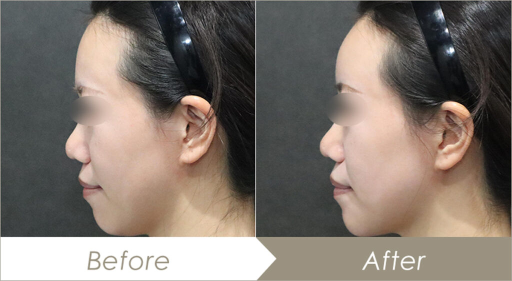 額（おでこ）ヒアルロン酸注入の施術例